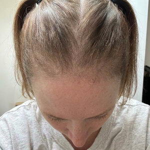 Before - Ingvild, 45