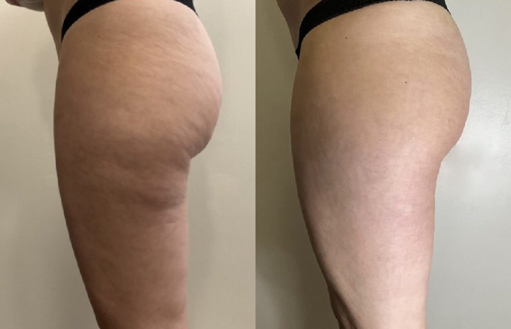 Silk Anti-Cellulite Oil Med Kollagen